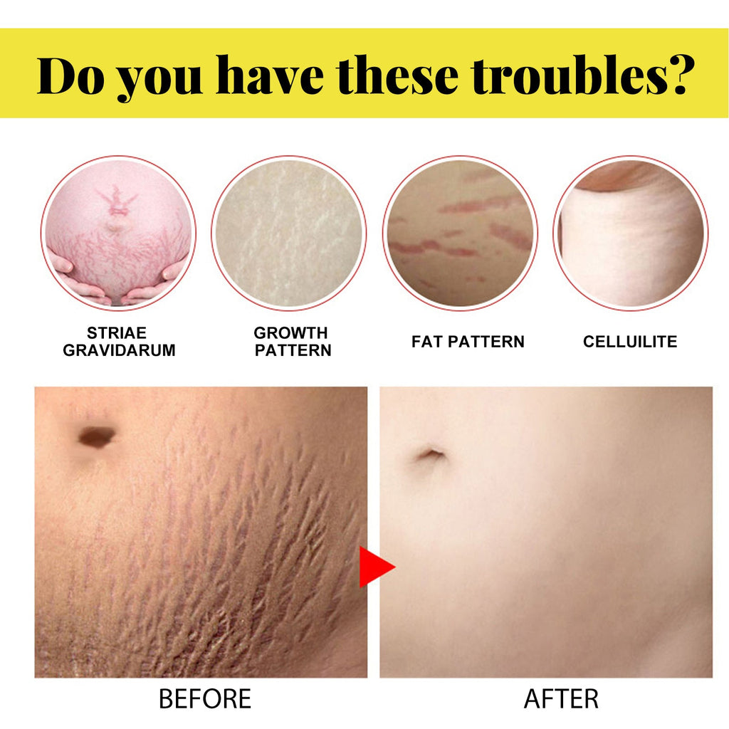 Skin Care Cream, Pregnant Women's Body Skin Gentle Repair Daily Care Moisturizing Moisturizer