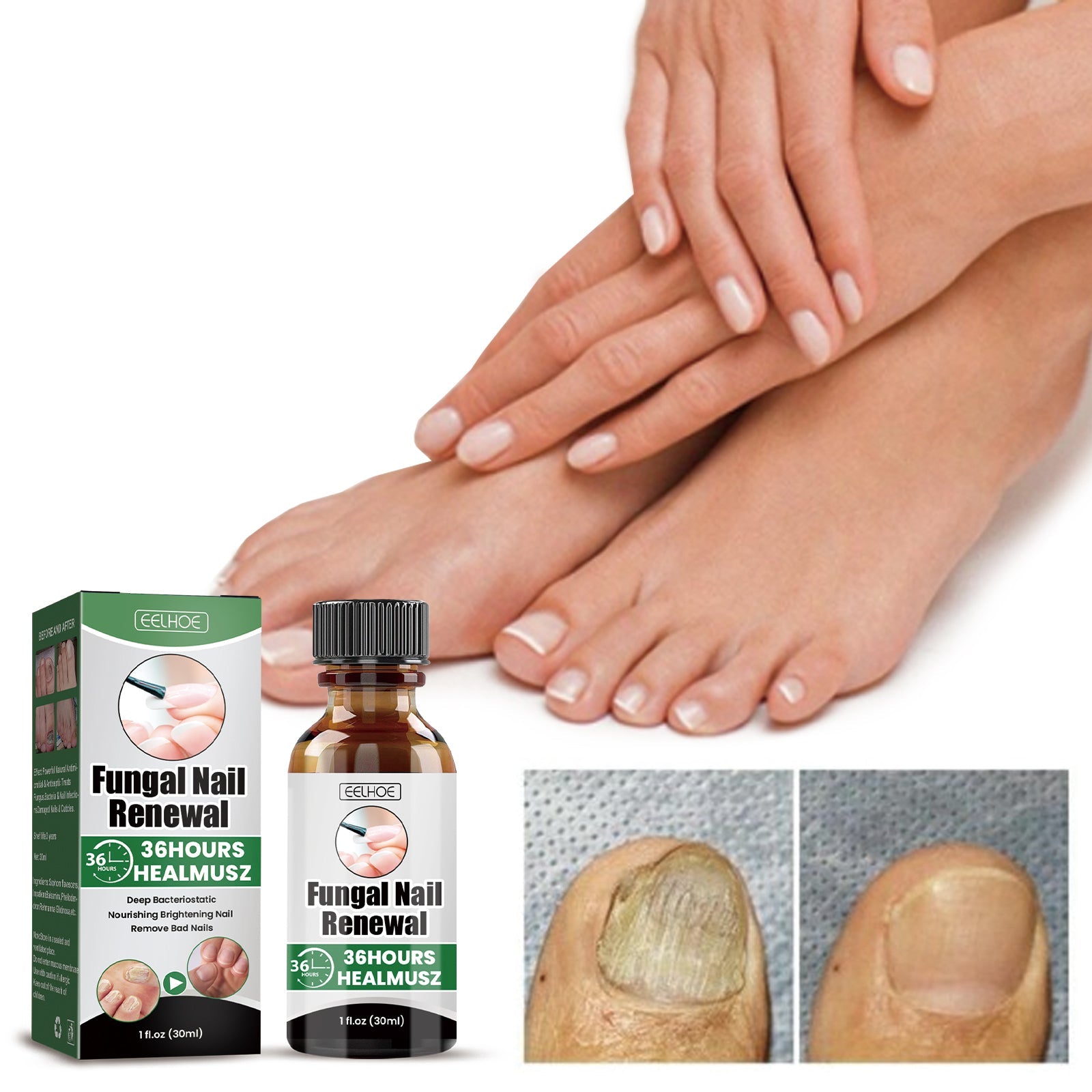 EELHOE Gray Nail Repair Remove Gray Nail Nourishing Lotion, Brightening Soft Nails Moisturizing Nail Care Solution For Hands, Feet And Nails