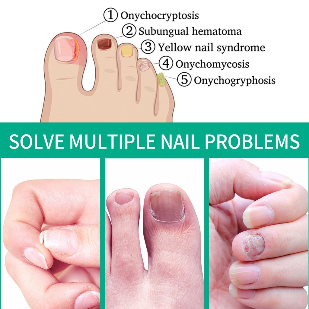 South Moon Nail Care Essence Moisturizes And Cleanses Hands, Feet And Nails And Brightening Nails Daily Care Essence