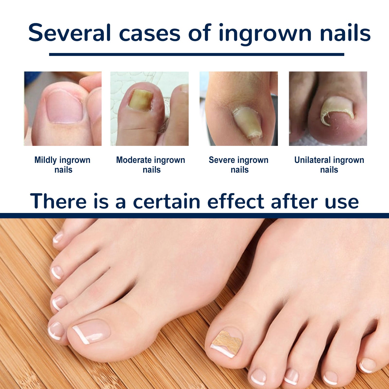 Nail Correction Patch, Nail Insert Correction And Repair Toe Manicure Nail Patch