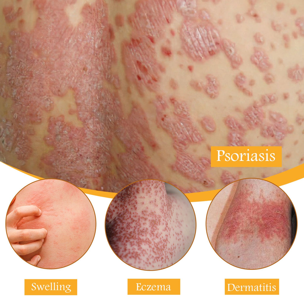 Bee Venom Psoriasis Relief Cream, Skin Relief Itching Relieve Redness Hand And Foot Moss Skin Moss Repair Cream