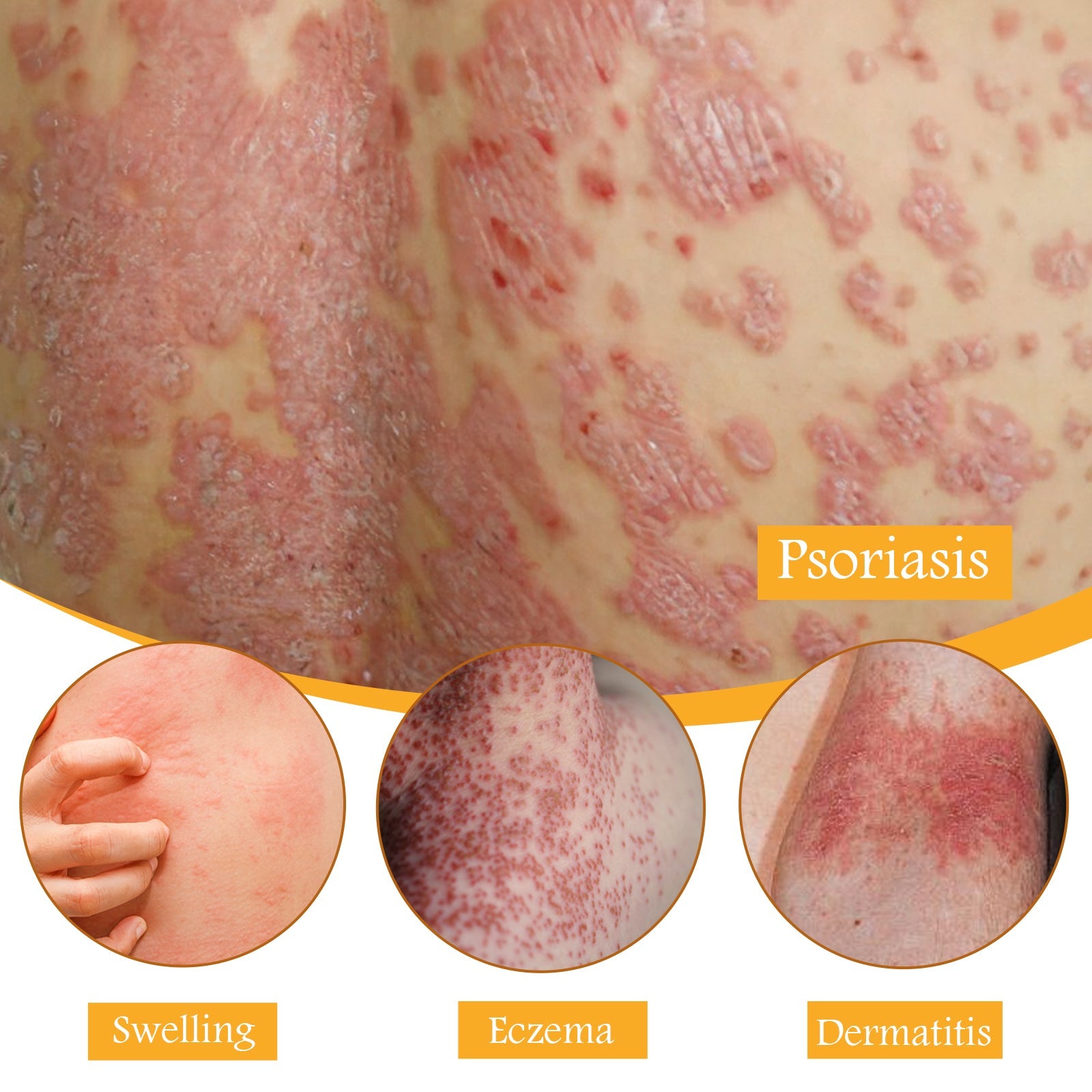 Bee Venom Psoriasis Relief Cream, Skin Relief Itching Relieve Redness Hand And Foot Moss Skin Moss Repair Cream
