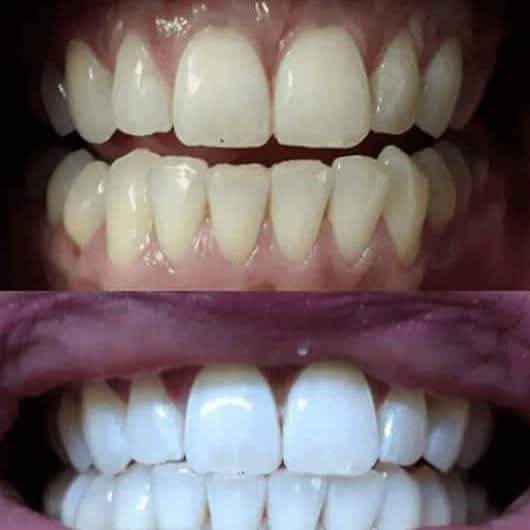TrueWhite Advanced Plus 2 Person Whitening System