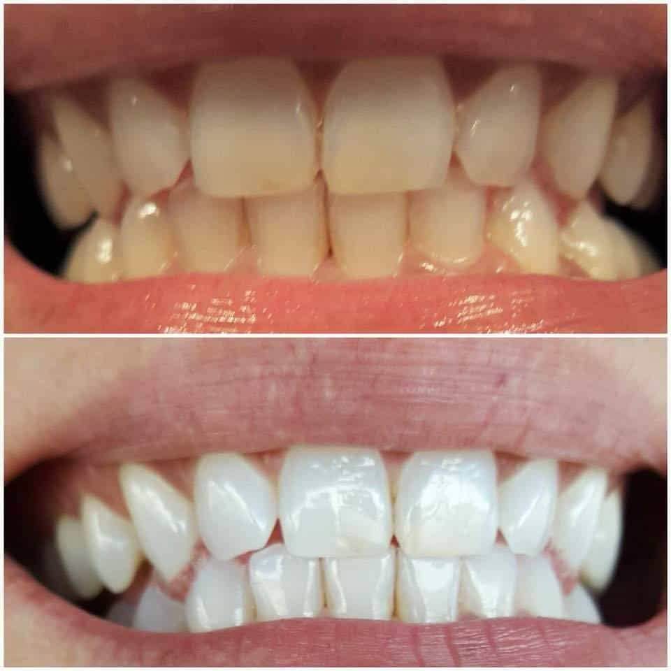 TrueWhite Advanced Plus 2 Person Whitening System